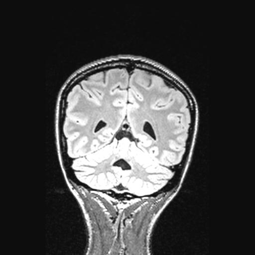 Atretic encephalocoele with inferior vermis hypoplasia (Radiopaedia 30443-31108 Coronal FLAIR 58).jpg