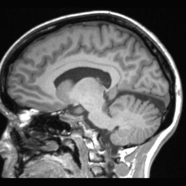 Atretic encephalocoele with inferior vermis hypoplasia (Radiopaedia 30443-31108 Sagittal T1 57).jpg