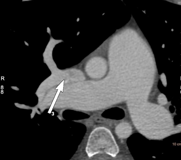 File:Atrial septal defect (upper sinus venosus type) with partial anomalous pulmonary venous return into superior vena cava (Radiopaedia 73228-84051 C+ arterial phase 2).jpeg