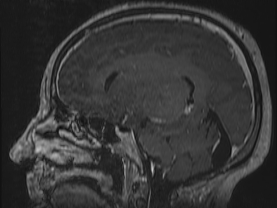 Atypical meningioma (Radiopaedia 62985-71406 Sagittal T1 C+ 51).jpg