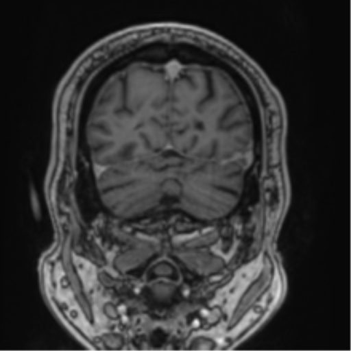 Atypical meningioma (WHO grade II) with brain invasion (Radiopaedia 57767-64729 Coronal T1 C+ 71).png