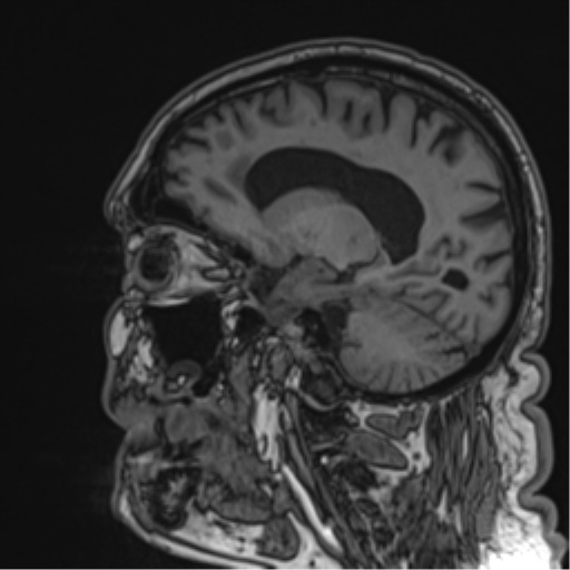 Atypical meningioma (WHO grade II) with brain invasion (Radiopaedia 57767-64729 Sagittal T1 29).png