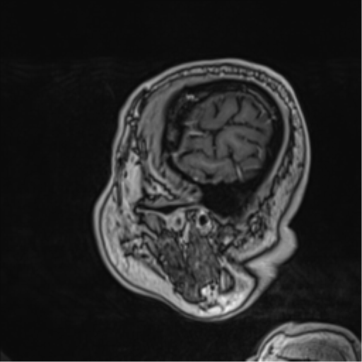 Atypical meningioma (WHO grade II) with brain invasion (Radiopaedia 57767-64729 Sagittal T1 C+ 14).png