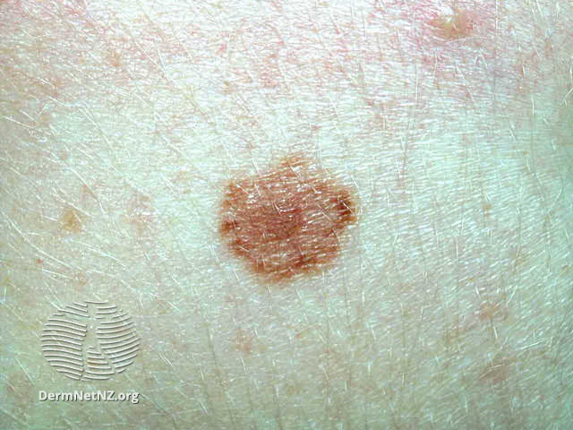 File:Atypical naevus (DermNet NZ doctors-lesions-images-target).jpg