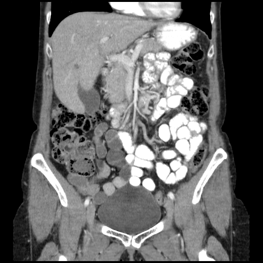 File:Atypical renal cyst (Radiopaedia 17536-17251 C 25).jpg