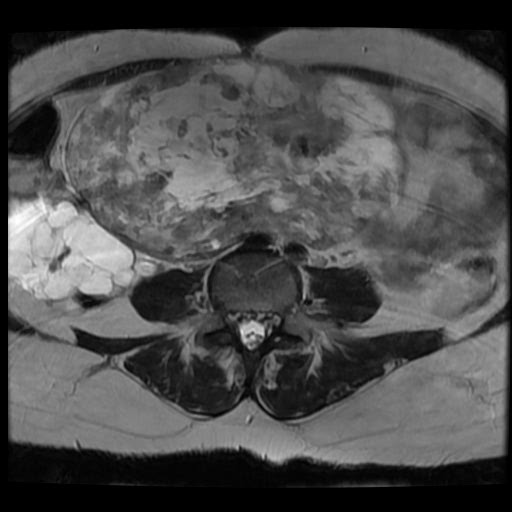 File:Atypical retroperitoneal lymphocoeles with large leiomyoma of uterus (Radiopaedia 32084-33027 Axial T2 7).jpg