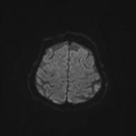 Autoimmune limbic encephalitis (Radiopaedia 30363-31005 Axial B0 and DWI 58).jpg