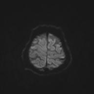 Autoimmune limbic encephalitis (Radiopaedia 30363-31005 Axial B0 and DWI 60).jpg