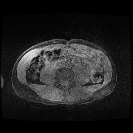 Autoimmune pancreatitis (Radiopaedia 69751-79729 Axial T1 C+ fat sat 111).jpg
