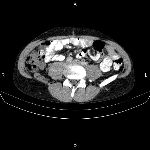 Autoimmune pancreatitis (Radiopaedia 84925-100431 B 35).jpg