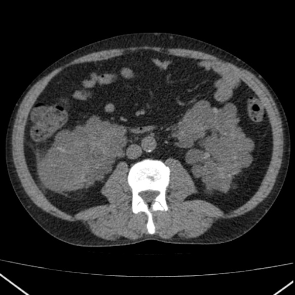 File:Autosomal dominant polycystic kidney disease (Radiopaedia 36539-38101 Axial non-contrast 46).jpg