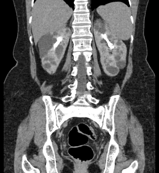Autosomal dominant polycystic kidney disease (Radiopaedia 38189-40194 Coronal C+ delayed 73).jpg