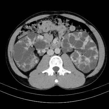 Autosomal dominant polycystic kidney disease (Radiopaedia 66349-75582 B 47).jpg