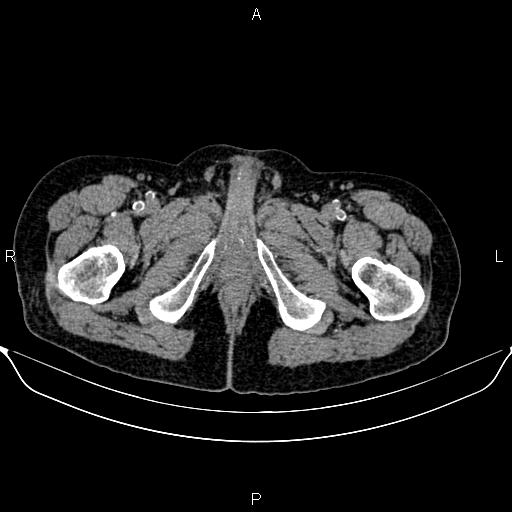 Autosomal dominant polycystic kidney disease (Radiopaedia 87830-104287 Axial non-contrast 59).jpg