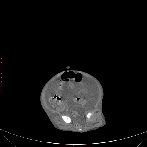 File:Autosomal recessive polycystic kidney disease associated with Caroli disease (Radiopaedia 61932-69984 Axial non-contrast 317).jpg