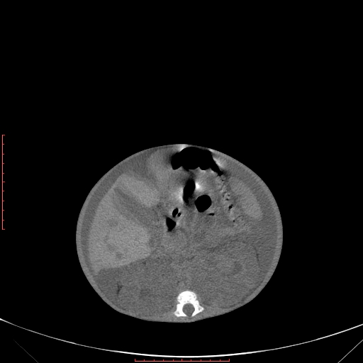 Autosomal recessive polycystic kidney disease associated with Caroli disease (Radiopaedia 61932-69984 B 193).jpg