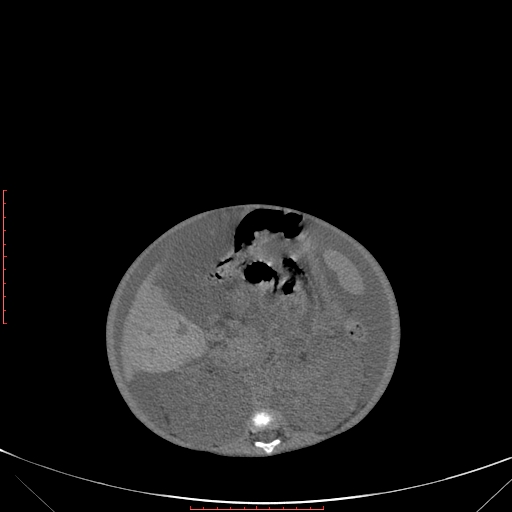 Autosomal recessive polycystic kidney disease associated with Caroli disease (Radiopaedia 61932-69984 B 203).jpg