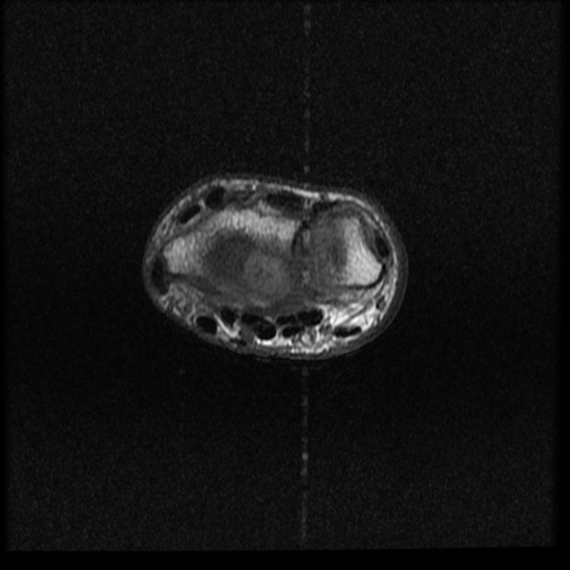 File:Avascular necrosis - scaphoid non-union (Radiopaedia 63457-72065 Axial T1 15).jpg