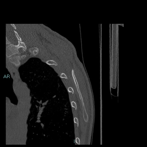 Avascular necrosis after fracture dislocations of the proximal humerus (Radiopaedia 88078-104655 Sagittal bone window 88).jpg