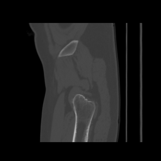 Avascular necrosis of the hip (Radiopaedia 61503-69467 B 55).jpg