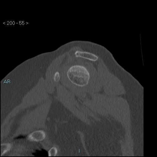 Avascular necrosis of the shoulder - Cruess stage I (Radiopaedia 77674-89887 Sagittal bone window 54).jpg