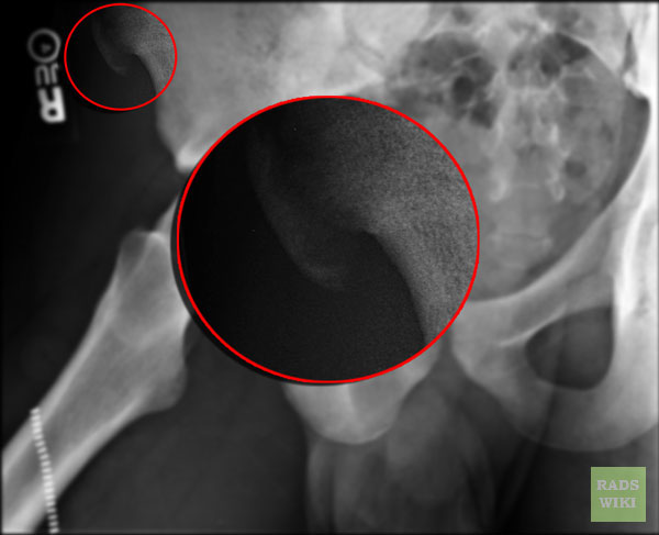 File:Avulsion fracture - anterior superior iliac spine (Radiopaedia 11227-37112 None 2).jpg