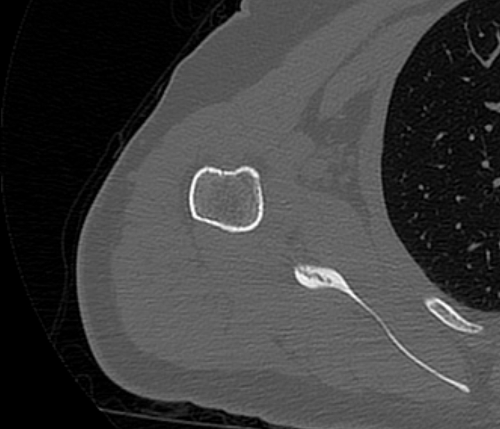Avulsion fracture - greater tuberosity of humerus (Radiopaedia 71216-81514 Axial bone window 54).jpg