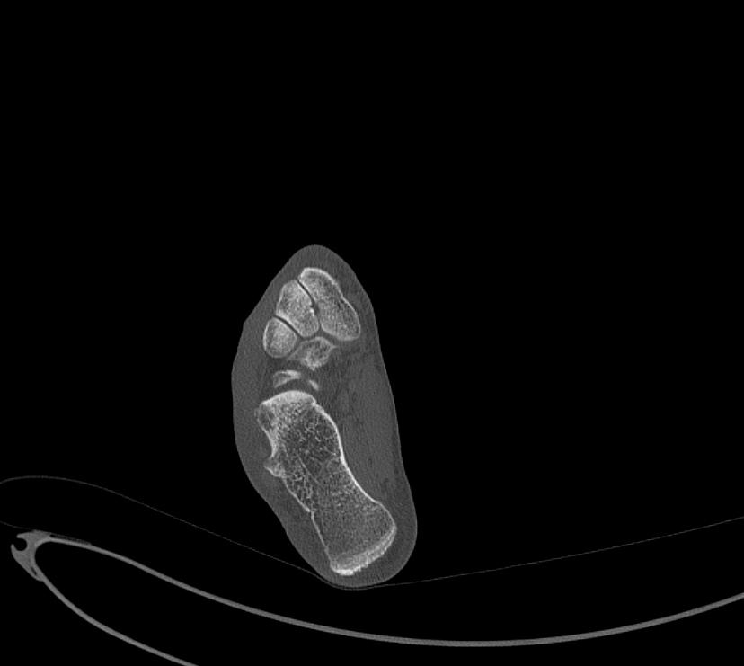 Avulsion fractures of talus and calcaneus (Radiopaedia 48277-53155 Axial bone window 78).jpg