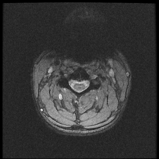 File:Axis fracture - MRI (Radiopaedia 71925-82375 Axial T2 fat sat 10).jpg