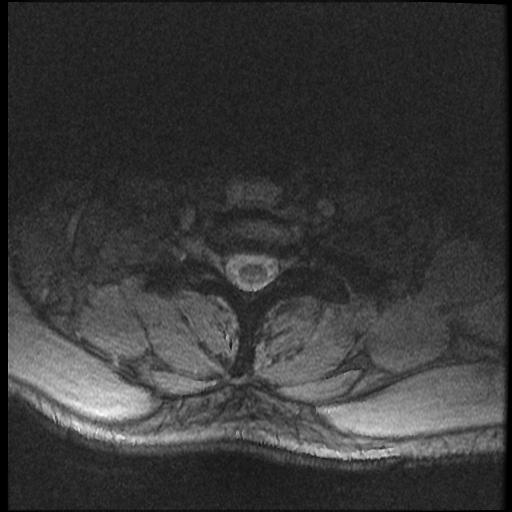 File:Axis fracture - MRI (Radiopaedia 71925-82375 Axial T2 fat sat 20).jpg