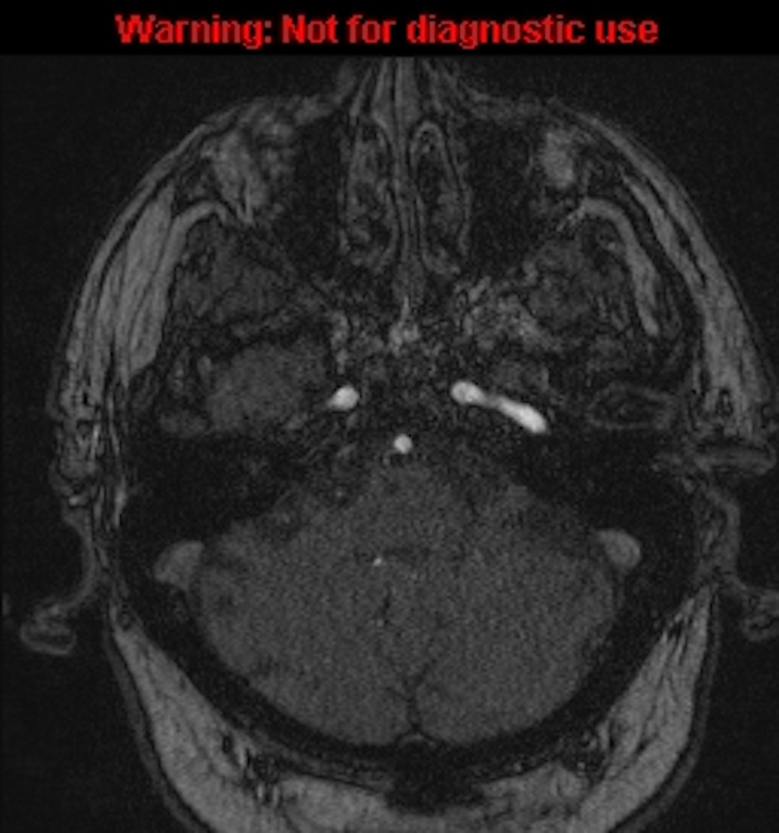 Azygos anterior cerebral artery (Radiopaedia 59325-66677 Axial MRA 30).jpg