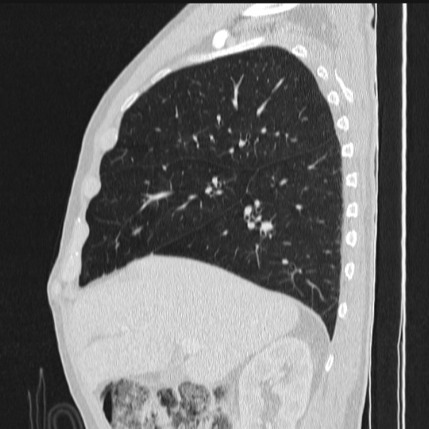Azygos lobe (Radiopaedia 38259-40275 lung window 32).jpg