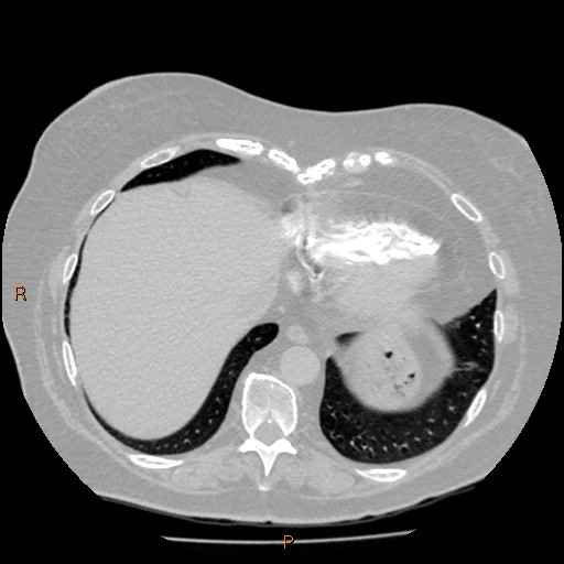 Azygos lobe (Radiopaedia 40161-42821 Axial lung window 61).jpg