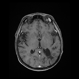 Balo concentric sclerosis (Radiopaedia 53875-59982 Axial LAVA C+ 138).jpg