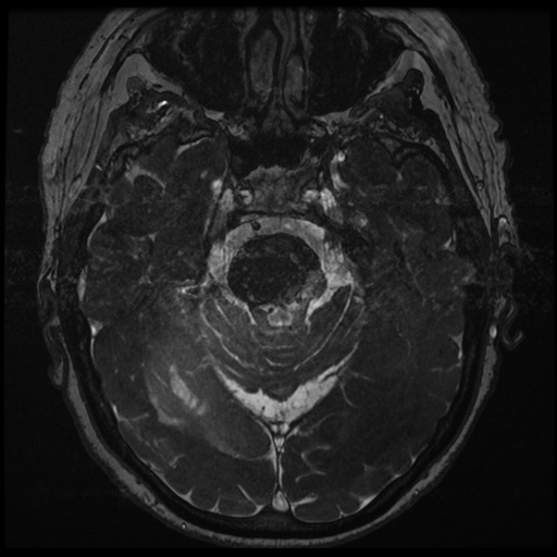 File:Balo concentric sclerosis (Radiopaedia 53875-59982 Axial T2 FIESTA 60).jpg