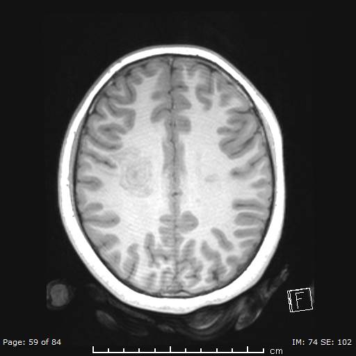 Balo concentric sclerosis (Radiopaedia 61637-69636 Axial T1 59).jpg
