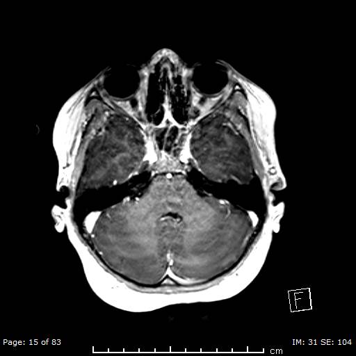 Balo concentric sclerosis (Radiopaedia 61637-69636 Axial T1 C+ 15).jpg