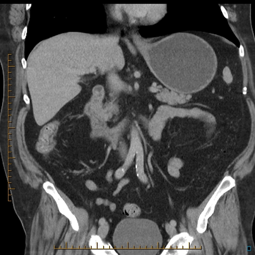 File:Bariatric balloon causing gastric outlet obstruction (Radiopaedia 54449-60672 B 30).jpg