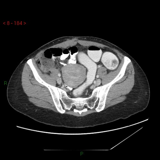 Bartholin gland cyst (Radiopaedia 54904-61181 A 46).jpg