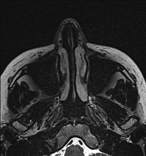Basal cell carcinoma - nasal region (Radiopaedia 70292-80365 Axial Gradient Echo 5).jpg