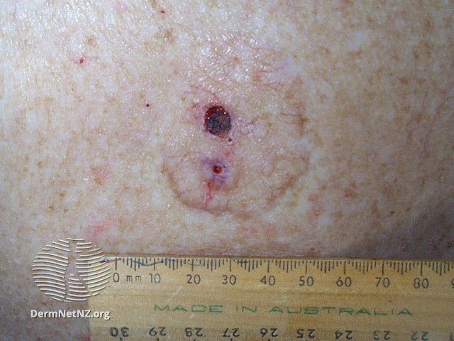 File:Basal cell carcinoma affecting the trunk (DermNet NZ lesions-bcc-trunk-1244).jpg