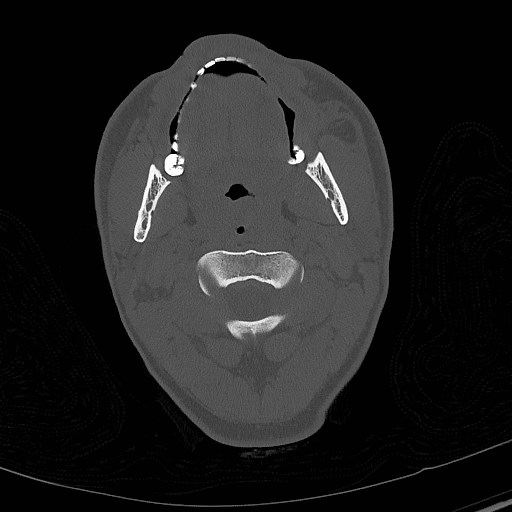 File:Base of skull fracture with bilateral Le Fort fractures (Radiopaedia 47094-51638 Axial bone window 6).jpg