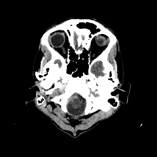 File:Basilar artery perforator aneurysm (Radiopaedia 82455-96597 Axial non-contrast 2).jpg