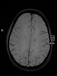 Basilar artery perforator aneurysm (Radiopaedia 82455-99523 Axial SWI 44).jpg
