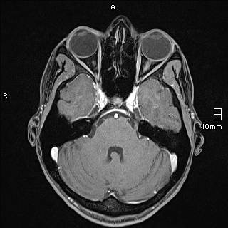 Basilar artery perforator aneurysm (Radiopaedia 82455-99523 G 36).jpg