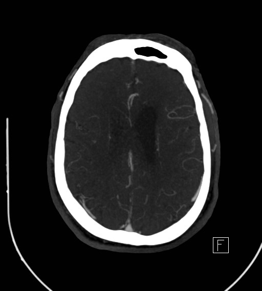 Basilar artery thrombosis (Radiopaedia 26986-27163 A 60).jpg