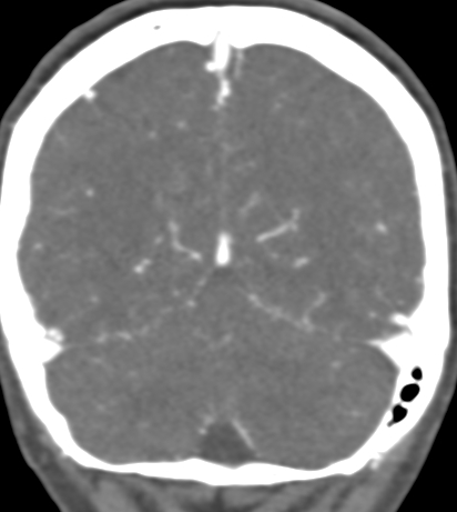 Basilar tip aneurysm with coiling (Radiopaedia 53912-60086 B 123).jpg