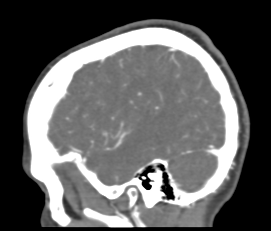 Basilar tip aneurysm with coiling (Radiopaedia 53912-60086 C 110).jpg