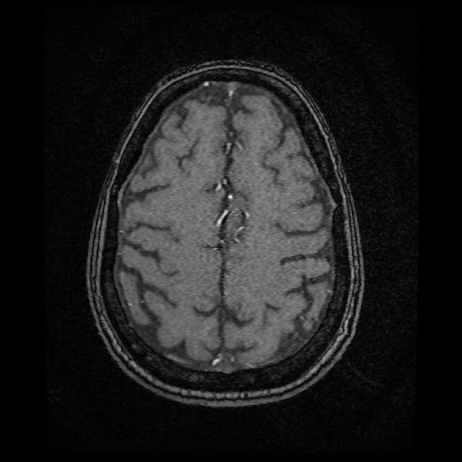 Basilar top and left middle cerebral artery aneurysm (Radiopaedia 61965-70031 Axial MRA 136).jpg