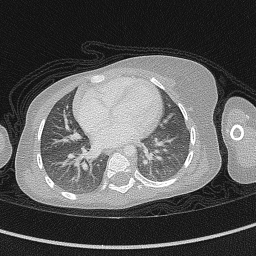Beckwith-Wiedeman syndrome with bilateral Wilms tumors (Radiopaedia 60850-68629 Axial lung window 39).jpg
